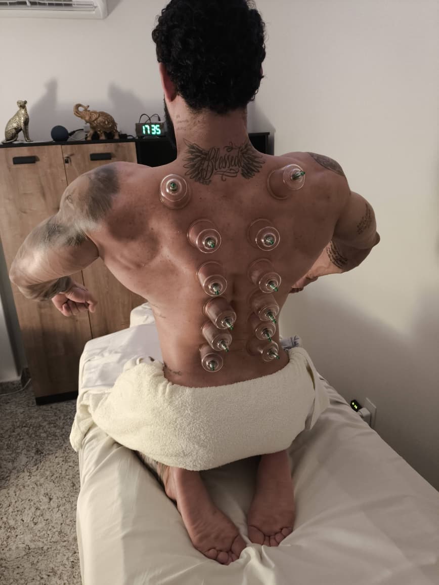 Ventosaterapia aplicada nas costas